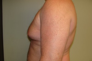 Gynecomastia Before and After 17 | Grover Aesthetics
