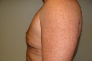Gynecomastia Before and After 17 | Grover Aesthetics