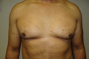 Gynecomastia Before and After | Grover Aesthetics