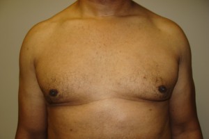 Gynecomastia Before and After | Grover Aesthetics