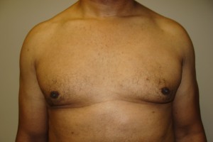 Gynecomastia Before and After 18 | Sanjay Grover MD FACS