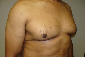 Gynecomastia Before and After 18 | Grover Aesthetics