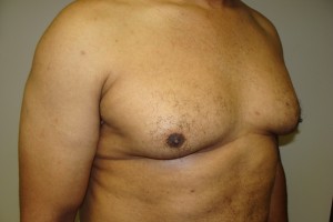 Gynecomastia Before and After 18 | Sanjay Grover MD FACS