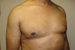 Gynecomastia Before and After 18 | Sanjay Grover MD FACS