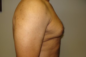 Gynecomastia Before and After 18 | Grover Aesthetics