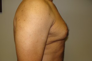 Gynecomastia Before and After 18 | Sanjay Grover MD FACS