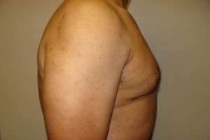 Gynecomastia Before and After 18 | Grover Aesthetics