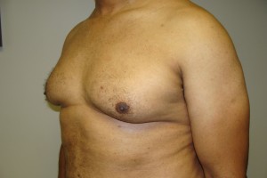 Gynecomastia Before and After 18 | Grover Aesthetics
