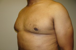 Gynecomastia Before and After 18 | Sanjay Grover MD FACS