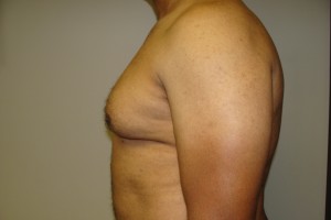 Gynecomastia Before and After 18 | Grover Aesthetics