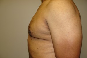 Gynecomastia Before and After 18 | Grover Aesthetics