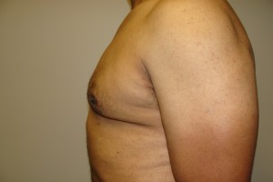 Gynecomastia Before and After 18 | Sanjay Grover MD FACS