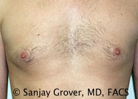 Gynecomastia Before and After | Grover Aesthetics