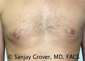 Gynecomastia Before and After 06 | Sanjay Grover MD FACS