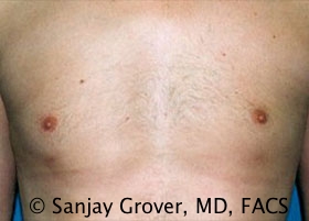 Gynecomastia Before and After | Grover Aesthetics