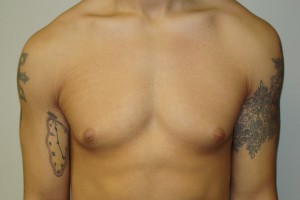 Gynecomastia Before and After | Grover Aesthetics