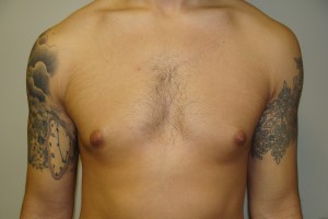 Gynecomastia Before and After | Grover Aesthetics