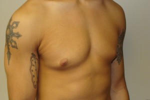 Gynecomastia Before and After 20 | Grover Aesthetics