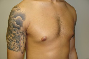Gynecomastia Before and After 20 | Grover Aesthetics