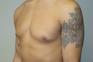 Gynecomastia Before and After 20 | Grover Aesthetics