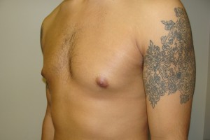 Gynecomastia Before and After 20 | Grover Aesthetics