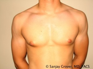 Gynecomastia Before and After | Grover Aesthetics