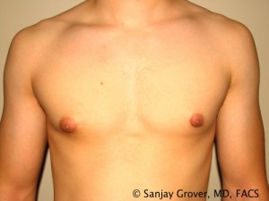 Gynecomastia Before and After | Grover Aesthetics