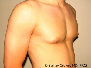 Gynecomastia Before and After 21 | Sanjay Grover MD FACS