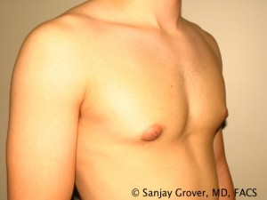 Gynecomastia Before and After 21 | Sanjay Grover MD FACS