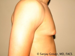 Gynecomastia Before and After 21 | Grover Aesthetics