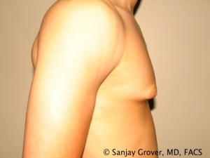 Gynecomastia Before and After 21 | Sanjay Grover MD FACS