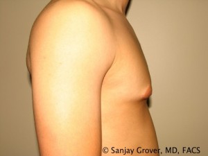 Gynecomastia Before and After 21 | Sanjay Grover MD FACS