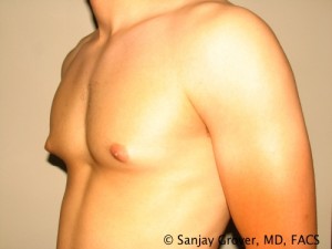 Gynecomastia Before and After 21 | Sanjay Grover MD FACS