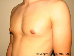 Gynecomastia Before and After 21 | Sanjay Grover MD FACS