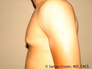 Gynecomastia Before and After 21 | Sanjay Grover MD FACS