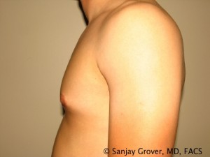 Gynecomastia Before and After 21 | Grover Aesthetics