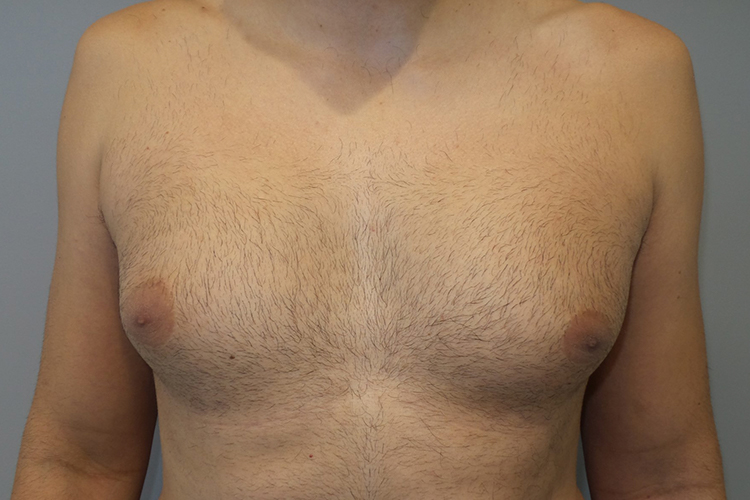 Gynecomastia Before and After | Grover Aesthetics