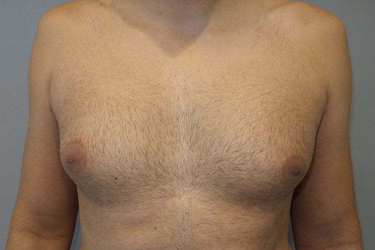 Gynecomastia Before and After | Sanjay Grover MD FACS