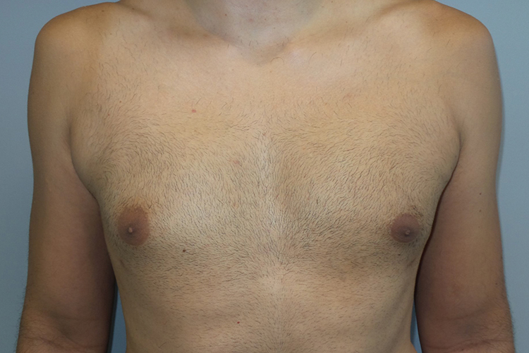 Gynecomastia Before and After | Grover Aesthetics