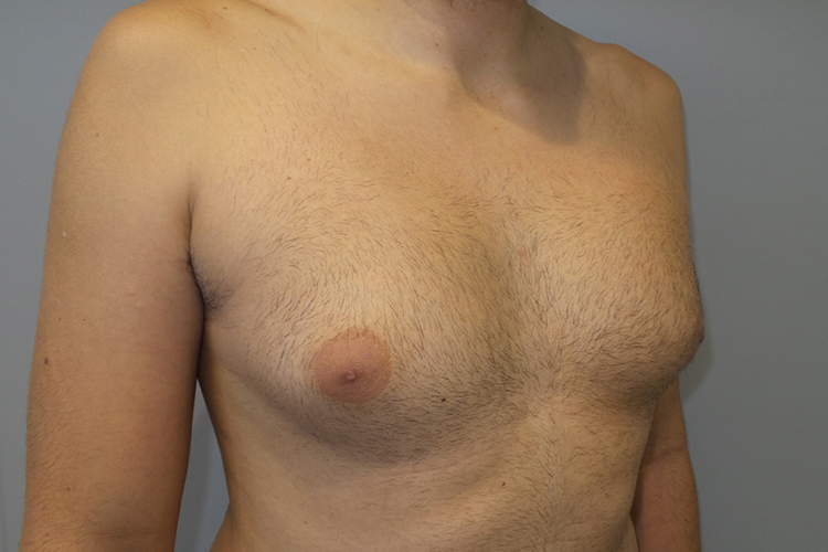 Gynecomastia Before and After 22 | Grover Aesthetics