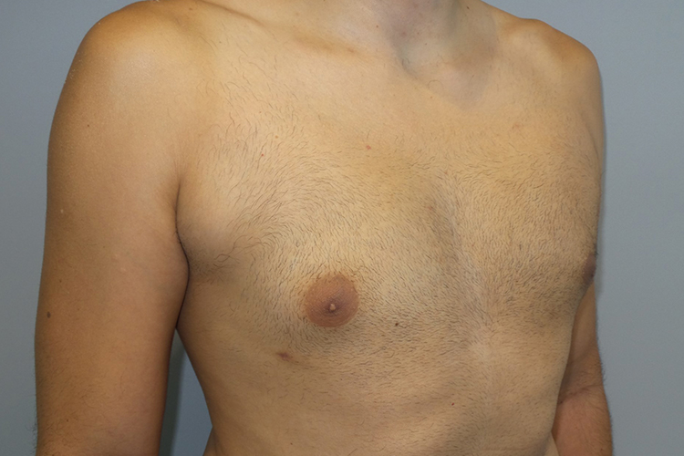 Gynecomastia Before and After 22 | Grover Aesthetics