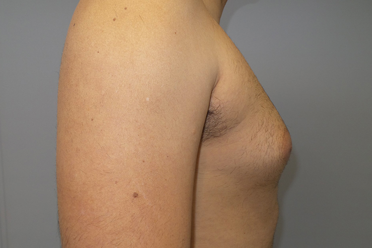 Gynecomastia Before and After 22 | Grover Aesthetics