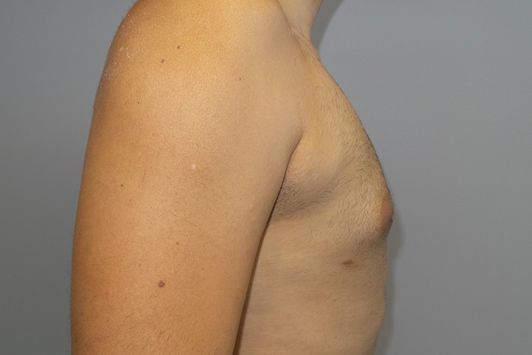 Gynecomastia Before and After 22 | Grover Aesthetics