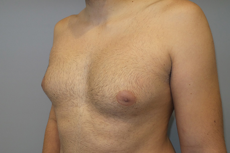 Gynecomastia Before and After 22 | Grover Aesthetics