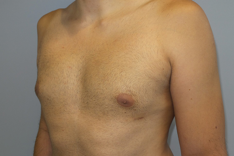 Gynecomastia Before and After 22 | Grover Aesthetics
