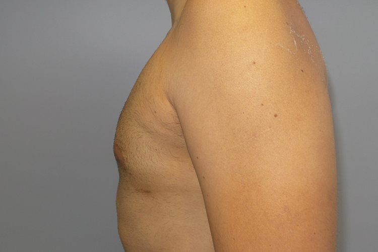 Gynecomastia Before and After 22 | Grover Aesthetics