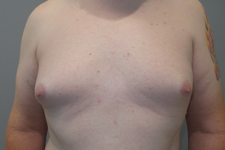 Gynecomastia Before and After | Grover Aesthetics
