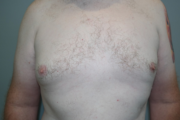 Gynecomastia Before and After | Grover Aesthetics