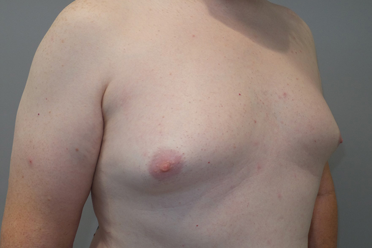 Gynecomastia Before and After 23 | Sanjay Grover MD FACS