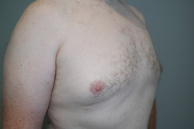 Gynecomastia Before and After 23 | Grover Aesthetics
